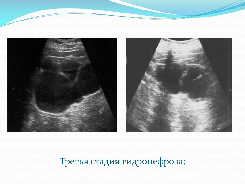 Третья стадия гидронефроза: